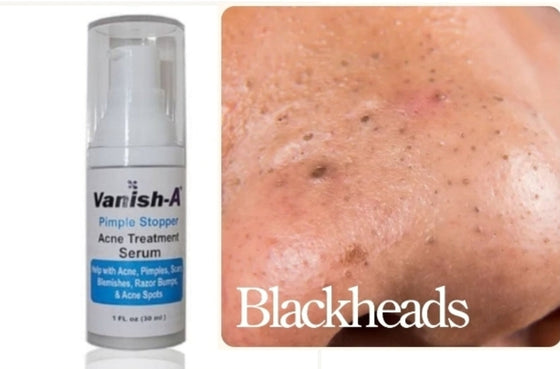 Pimple Stopper Acne Serum 1 .oz