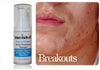 Pimple Stopper Acne Serum 1 .oz