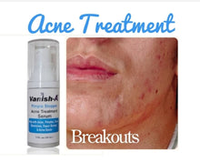  Pimple Stopper Acne Serum 1 .oz