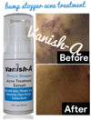 Pimple Stopper Acne Serum 1 .oz