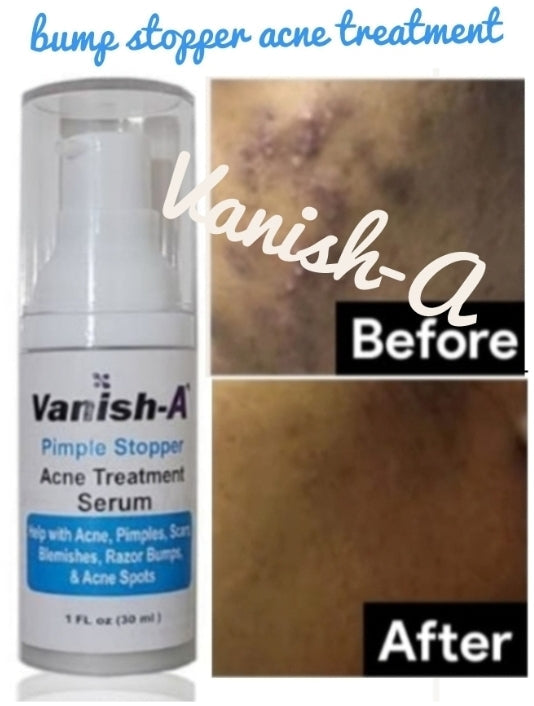 Pimple Stopper Acne Serum 1 .oz