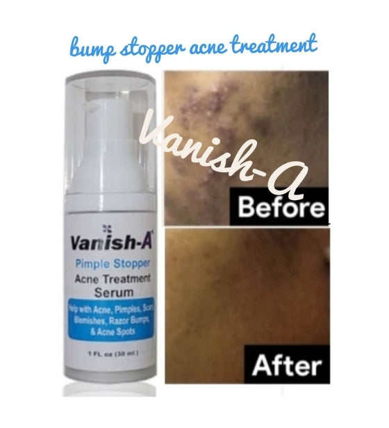 Pimple Stopper Acne Serum 1 .oz