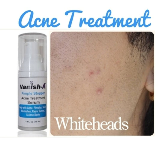Pimple Stopper Acne Serum 1 .oz
