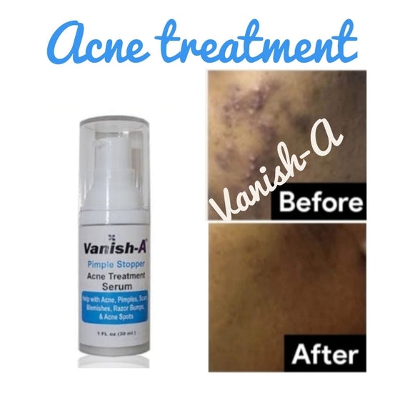 Pimple Stopper Acne Serum 1 .oz